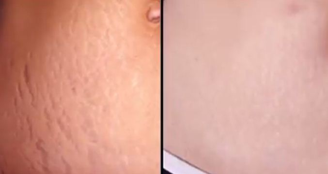 Клирвин тос
Арьсны язралтыг арилгана. Өдөрт 2 удаа өглөө оройд түрхэх. 2 долоо хоногийн дараа үр дүн нь гарна
